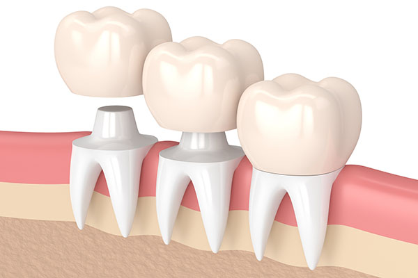 Dental Crowns Vs Tooth Extraction